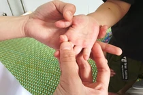 Bệnh nhân mắc tay chân miệng ở Quảng Nam tăng đột biến