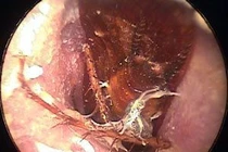 Cấp cứu vì gián trong tai