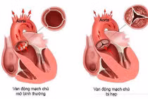 Xơ cứng và hẹp van động mạch chủ