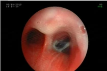 Hạt hồng xiêm xuyên phế quản 10 năm