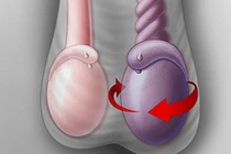 Xoắn tinh hoàn ẩn, bé 3 tuổi phải cắt bỏ tinh hoàn 