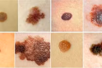 Nốt ruồi biến thành u ác tính như thế nào?