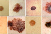 Nốt ruồi biến thành u ác tính như thế nào?