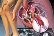  Đặt stent có khỏi tắc động mạch chi