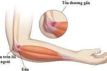 Hội chứng Tennis elbow