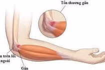 Hội chứng Tennis elbow