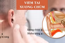 Nguy hiểm tính mạng vì chủ quan với viêm tai xương chũm