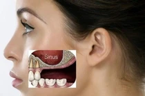 Viêm xoang hàm do đau răng