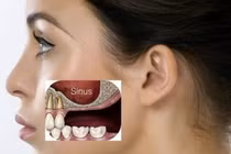 Viêm xoang hàm do đau răng