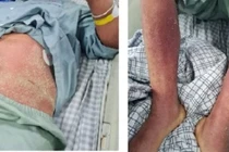 Sau khi mổ lợn một bệnh nhân nhiễm khuẩn huyết 