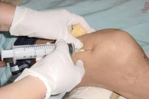 Các phương pháp tiêm điều trị thoái hóa khớp gối