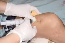 Các phương pháp tiêm điều trị thoái hóa khớp gối