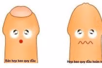 Hẹp bao quy đầu ảnh hưởng không nhỏ đến tình dục 