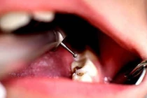 Nghiên cứu mới này sẽ khiến bạn không bao giờ dám quên đánh răng nữa