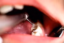 Nghiên cứu mới này sẽ khiến bạn không bao giờ dám quên đánh răng nữa