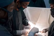 Bé gái 14 tuổi bị tắc ruột do ăn nhiều quả hồng ngâm