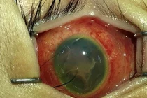 Mù mắt vì súng hơi