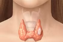 Mổ nội soi và mổ mở tuyến giáp