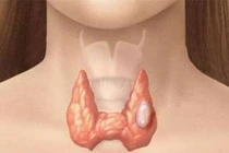 Mổ nội soi và mổ mở tuyến giáp