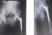 Đục xi măng “giải liệt” cho bệnh nhân hỏng khớp nhân tạo