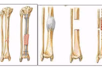 6 tháng chân gẫy chưa liền do khớp giả