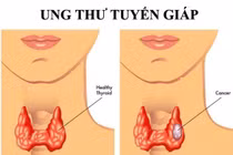 Ung thư tuyến giáp có phải do suy giảm miễn dịch?