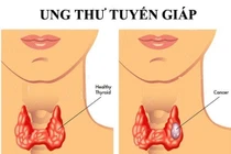 Ung thư tuyến giáp có phải do suy giảm miễn dịch?