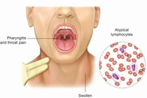 Virus EBV gây ung thư mũi họng