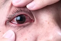 Bệnh nặng do sử dụng thuốc hết date