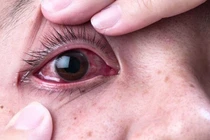 Bệnh nặng do sử dụng thuốc hết date