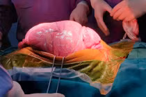 Hãi hùng với khối u khổng lồ trong ổ bụng