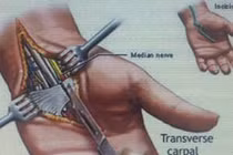 Hội chứng ống cổ tay – có thể teo cơ nếu điều trị muộn