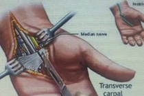Hội chứng ống cổ tay – có thể teo cơ nếu điều trị muộn