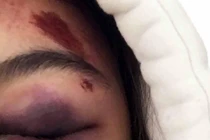 Miễn khởi tố 1 đối tượng trong vụ đánh hội đồng nữ sinh tại Lâm Đồng