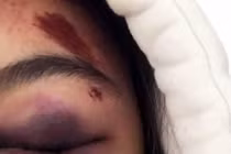 Miễn khởi tố 1 đối tượng trong vụ đánh hội đồng nữ sinh tại Lâm Đồng