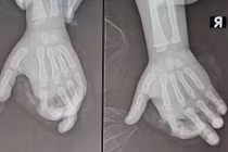 Bé 4 tuổi bị đứt rời ngón tay vì máy xay sinh tố 