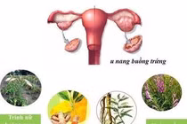  Bị u nang buồng trứng nhưng không muốn phẫu thuật? Hãy dùng ngay Nga Phụ Khang