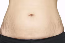 Phòng ngừa bị rạn da