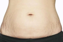 Phòng ngừa bị rạn da