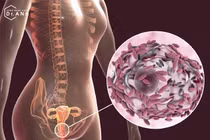 Nhiễm trùng hậu sản vì "không kiêng"