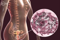 Nhiễm trùng hậu sản vì "không kiêng"