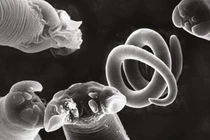 Tưởng bị bại liệt hóa ra giun xoắn