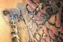 Vai nhiễm trùng vì xóa xăm