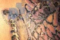 Vai nhiễm trùng vì xóa xăm