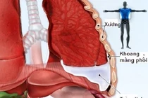 Viêm trung thất do thương tổn thực quản