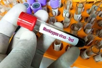 Việt Nam chưa cần thiết tiêm vắc xin bệnh đậu mùa khỉ 