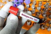 Việt Nam chưa cần thiết tiêm vắc xin bệnh đậu mùa khỉ 