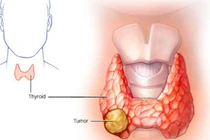 Tiêm cồn phối hợp với sóng cao tần điều trị các khối tuyến giáp lành tính