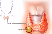 Tiêm cồn phối hợp với sóng cao tần điều trị các khối tuyến giáp lành tính