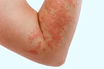 Dị ứng sulfa - Coi chừng biến chứng nguy hiểm